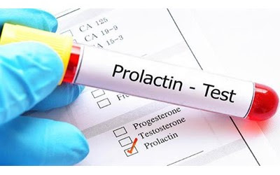 تست پرولاکتین