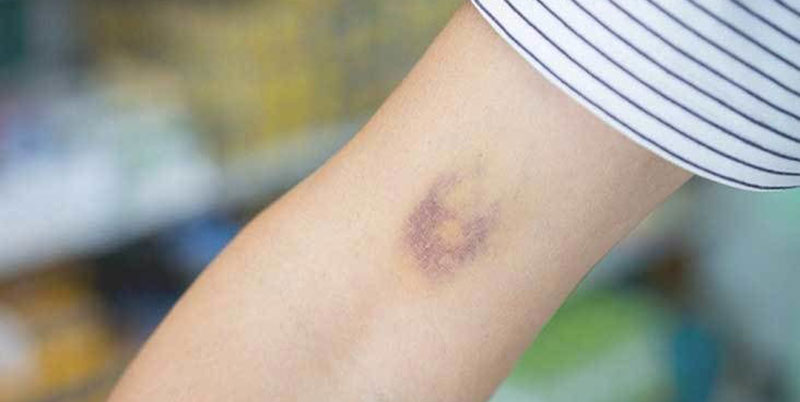 دلایل کبودی محل نمونه گیری